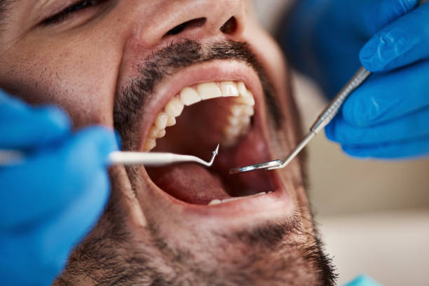 Best Emergency Wisdom Tooth Extraction in Pacific Grove, CA